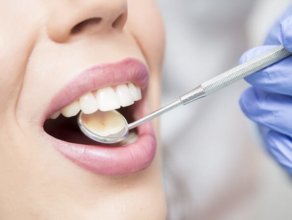 Keine Fixpreise für Zahnreinigung und Bleaching